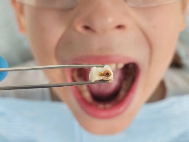 Best Broken or Cracked Tooth Emergency Dentist in Colfax, IA
